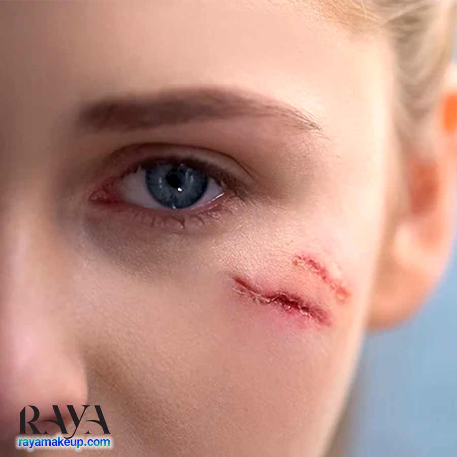 چگونه می توانیم اسکار و لک جای زخم روی پوست را از بین ببریم؟