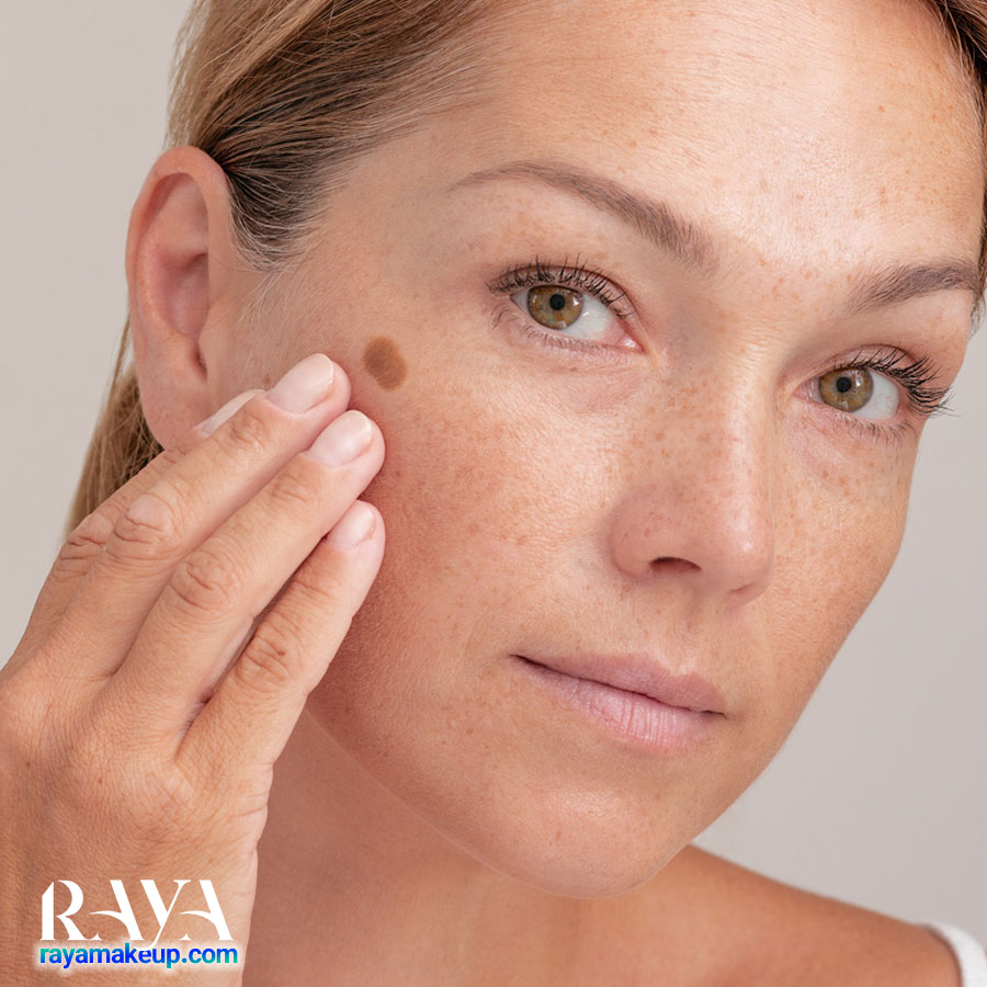 چگونه از شر لک های تیره و هایپرپیگمنتاسیون روی باسن خلاص شویم؟