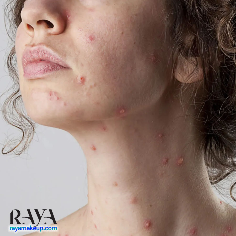 چگونه لک و اسکار آبله مرغان را برطرف کنیم؟ 