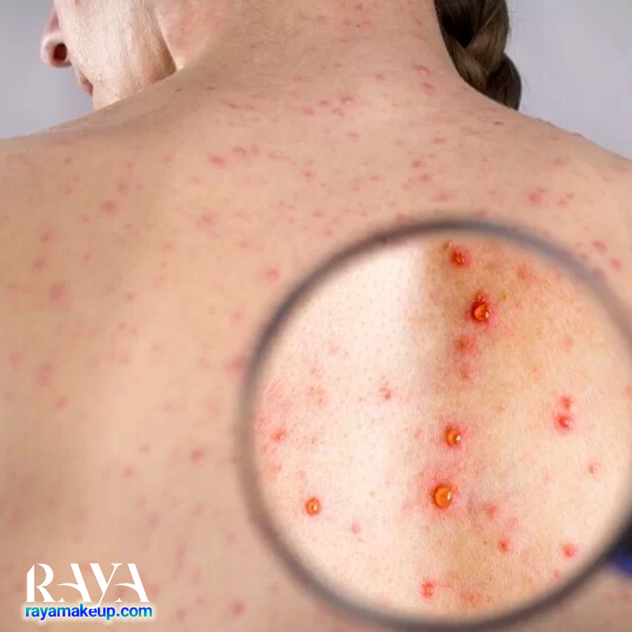 بررسی انواع جوش روی شانه و کتف به همراه روش های پیشگیری و درمان آنها