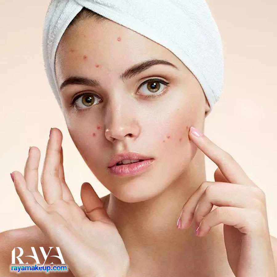 چه غذاهایی باعث جوش و آکنه می شوند؟