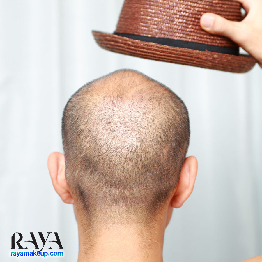 آیا کلاه باعث ریزش مو می شود؟ 