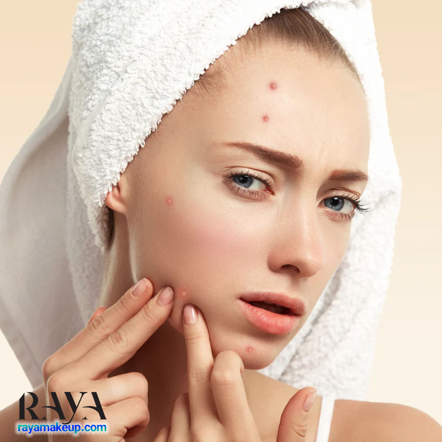 چه زمانی آکنه متوقف می شود؟ 