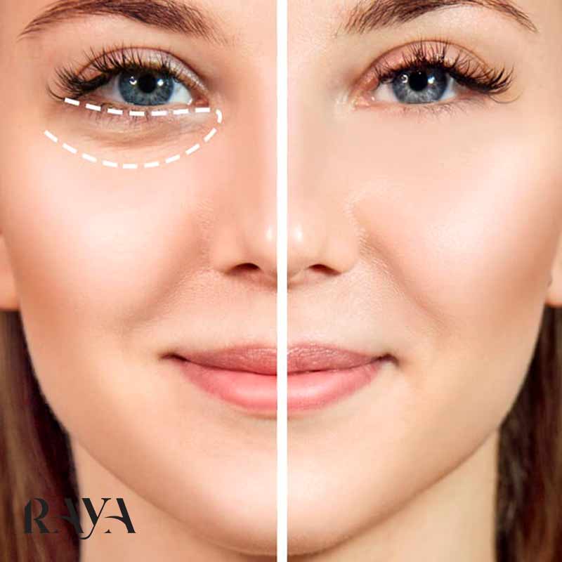 دلایل و راهکارهای عالی برای برطرف نمودن پف دور چشم